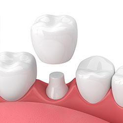 Dental Crowns at Majestic Dental