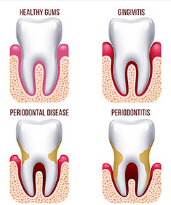 Gum Disease / Perio at Majestic Dental