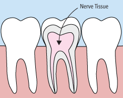 Root Canals at Majestic Dental