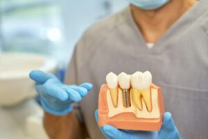 Closeup of a dentist at Majestic Dental in Cottleville, MO, holding a dental implant model, showcasing in-house dental implant services.