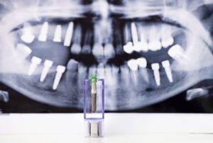 Dental implant model in front of panoramic X-ray showing multiple implants at Majestic Dental in Cottleville, MO