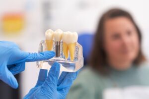 Dentist wearing blue gloves pointing to a dental implant model during a consultation at Majestic Dental in Cottleville, MO.
